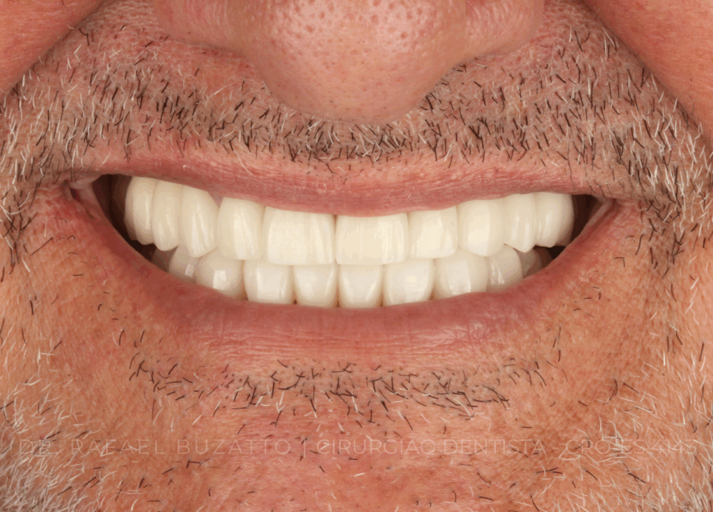 Tratamento realizado pelo Dr. Rafael Buzatto Cirurgiao Dentista CRO ES 4143 RB0710 01