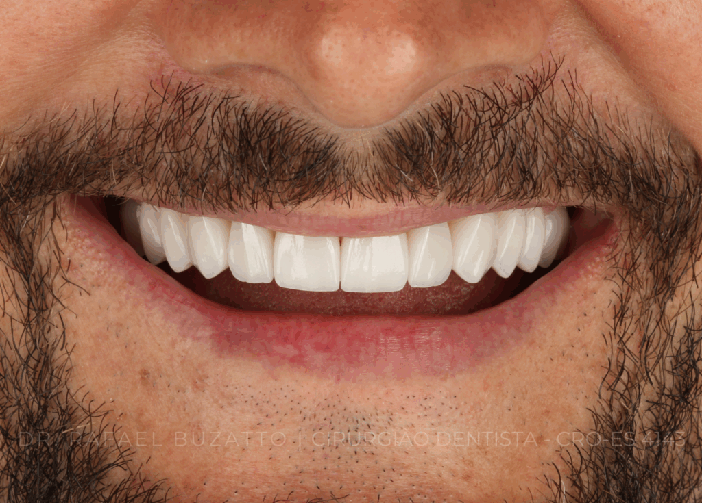 Tratamento realizado pelo Dr. Rafael Buzatto Cirurgiao Dentista CRO ES 4143 RB0710 02