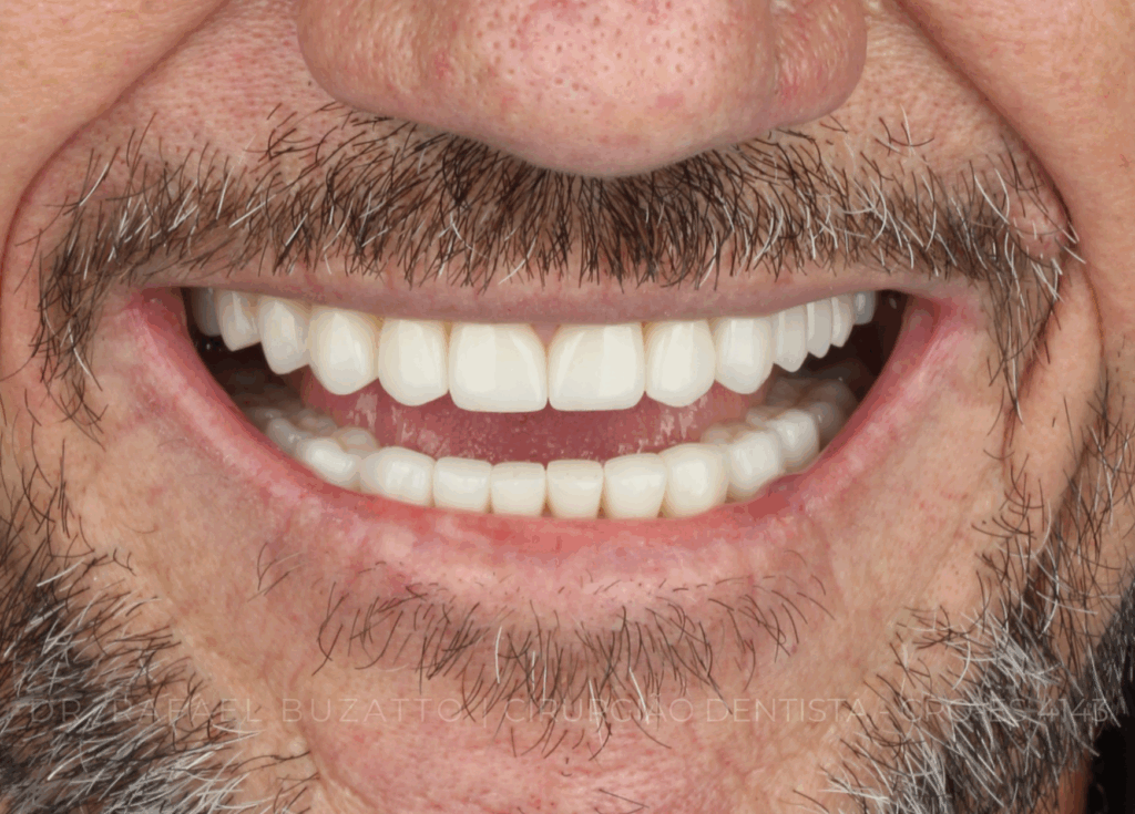 Tratamento realizado pelo Dr. Rafael Buzatto Cirurgiao Dentista CRO ES 4143 RB0710 03